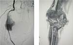 A Popliteal False Aneurysm Caused by an Avulsion Fracture of the Femur: a Case Presenting with Deep Venous Thrombosis - ePrints