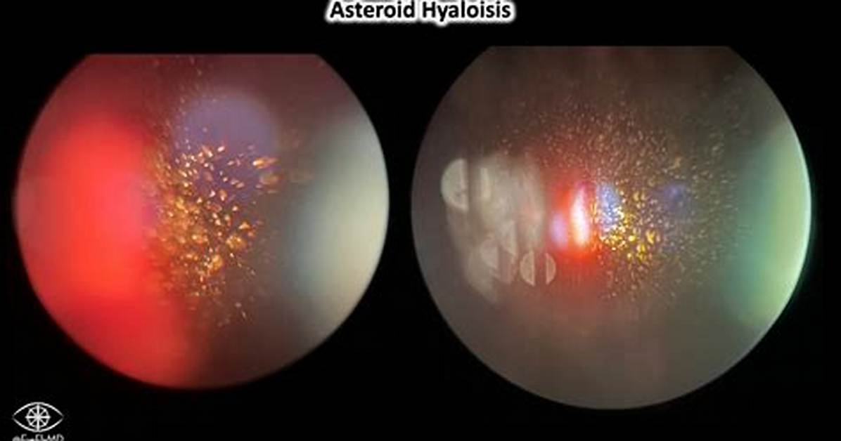 Asteroid Hyalosis - All About Vision