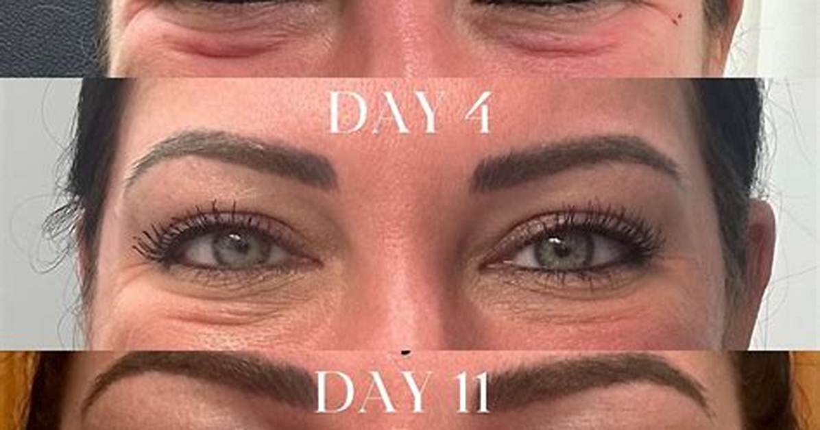 Botox Jelly Roll
