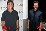 Has Jonathan Cheban Had Plastic Surgery?