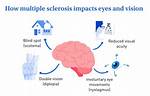 How Multiple Sclerosis Impacts Eyes and Vision