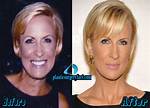 Mika Brzezinski Plastic Surgery: Before and After Photos