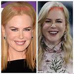 Nicole Kidman's Plastic Surgery Journey: Before and After