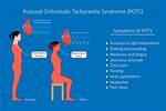 Postural Orthostatic Tachycardia Syndrome Is an Under-Recognized Condition in Chronic Fatigue Syndrome - ePrints