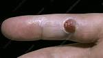 Pyogenic Granuloma