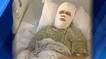 Savannah Grant Acid Attack: a Survivor's Story