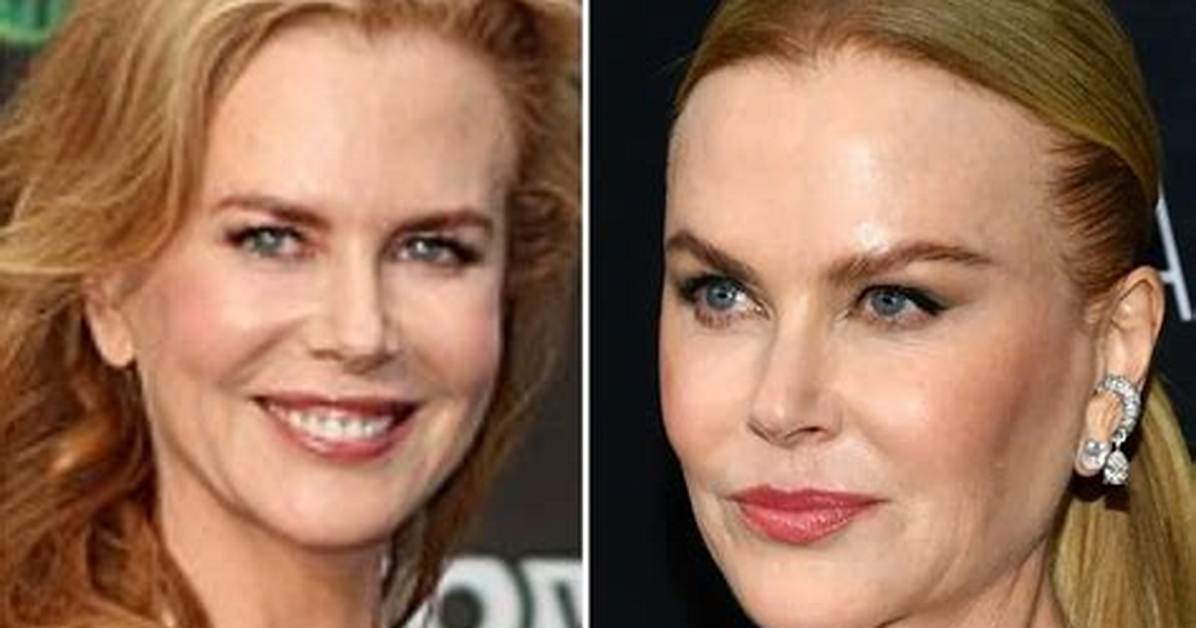 Unveiling the Truth: Does Nicole Kidman Have an Eating Disorder?