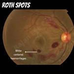 What Are Roth Spots? Causes, Diagnosis, Treatment & Pictures